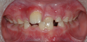 Anterior crossbite